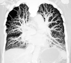 Utilisation de la tinzaparine et des antivitamines K chez des patients avec un �pisode aigu de thrombose veineuse profonde ou d'embolie pulmonaire&nbsp;: �tude de cohorte r�trospective