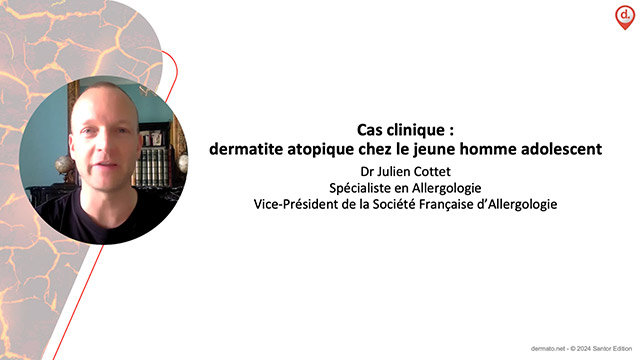 Cas clinique&nbsp;: dermatite atopique chez le jeune homme adolescent