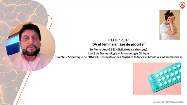 Cas clinique&nbsp;: DA et femme en �ge de procr�er
