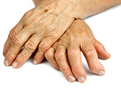 Traitement de la PR par TCZ&nbsp;: r�sultats de l��tude italienne TRUST