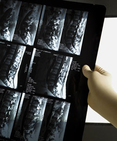 La spondylarthrite ankylosante est associ�e � une augmentation du risque de fractures vert�brales et de fractures non vert�brales cliniques&nbsp;: r�sultats d�une �tude de cohorte espagnole